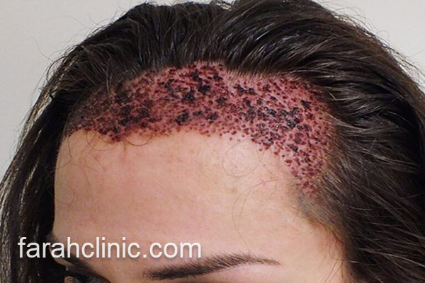 چرا کاشت مو از محبوبیت زیادی برخوردار است؟ | فرح کلینیک